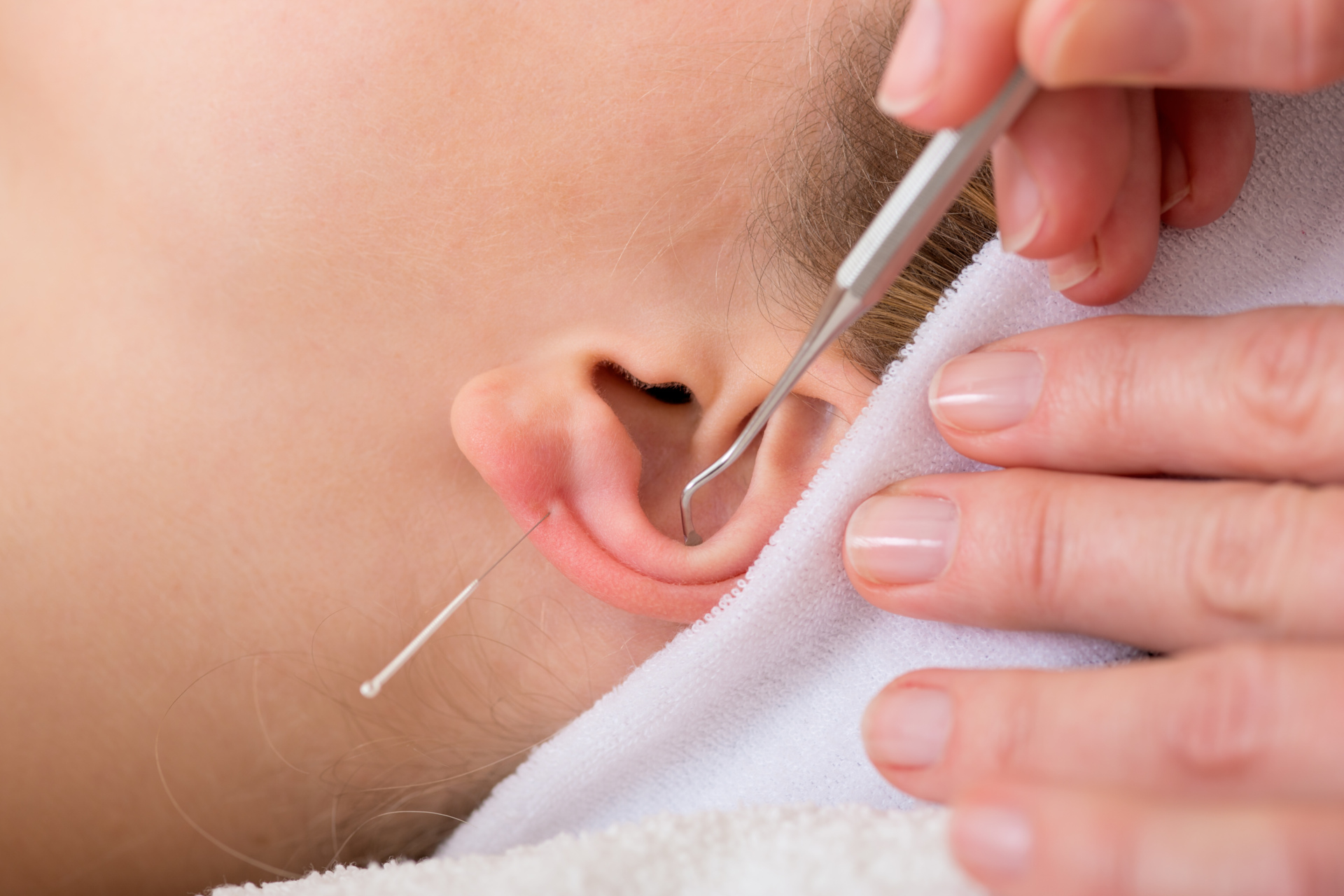 Someone receiving Auricular Therapy on their ears