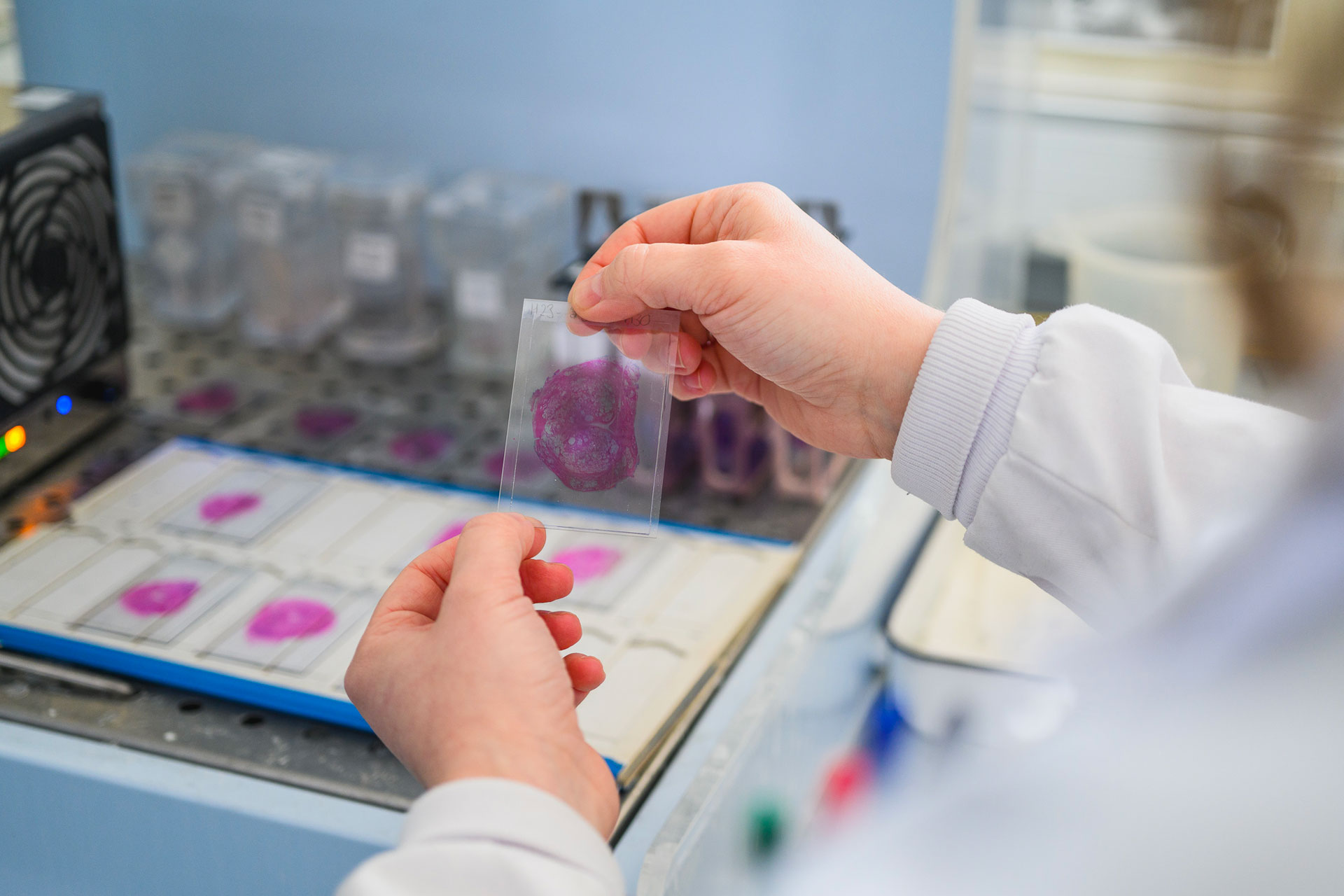 A scientist looks at a cancer cell in a lab