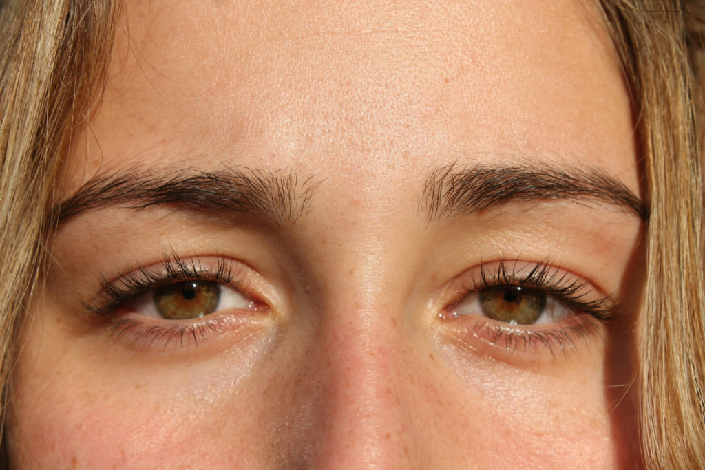 Close up of person's eyes with negative canthal tilt