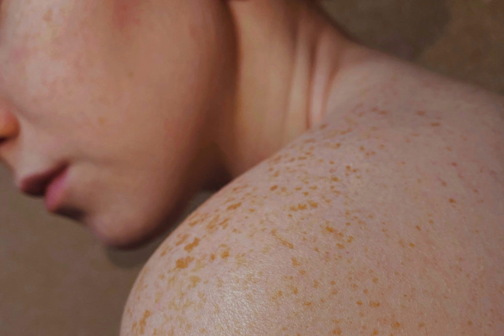 Close up of face and shoulder with freckles | skin microbiome