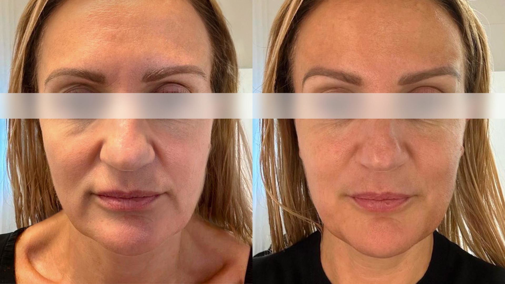 Before and after LYMA LIFT treatment photos