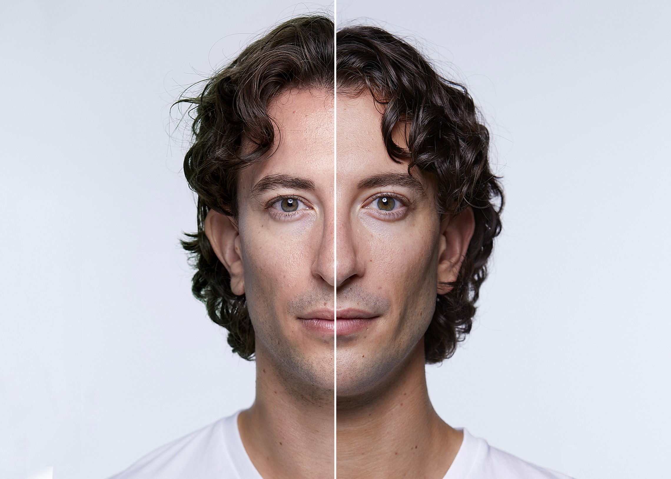 Before and after images of man treated with Restylane
