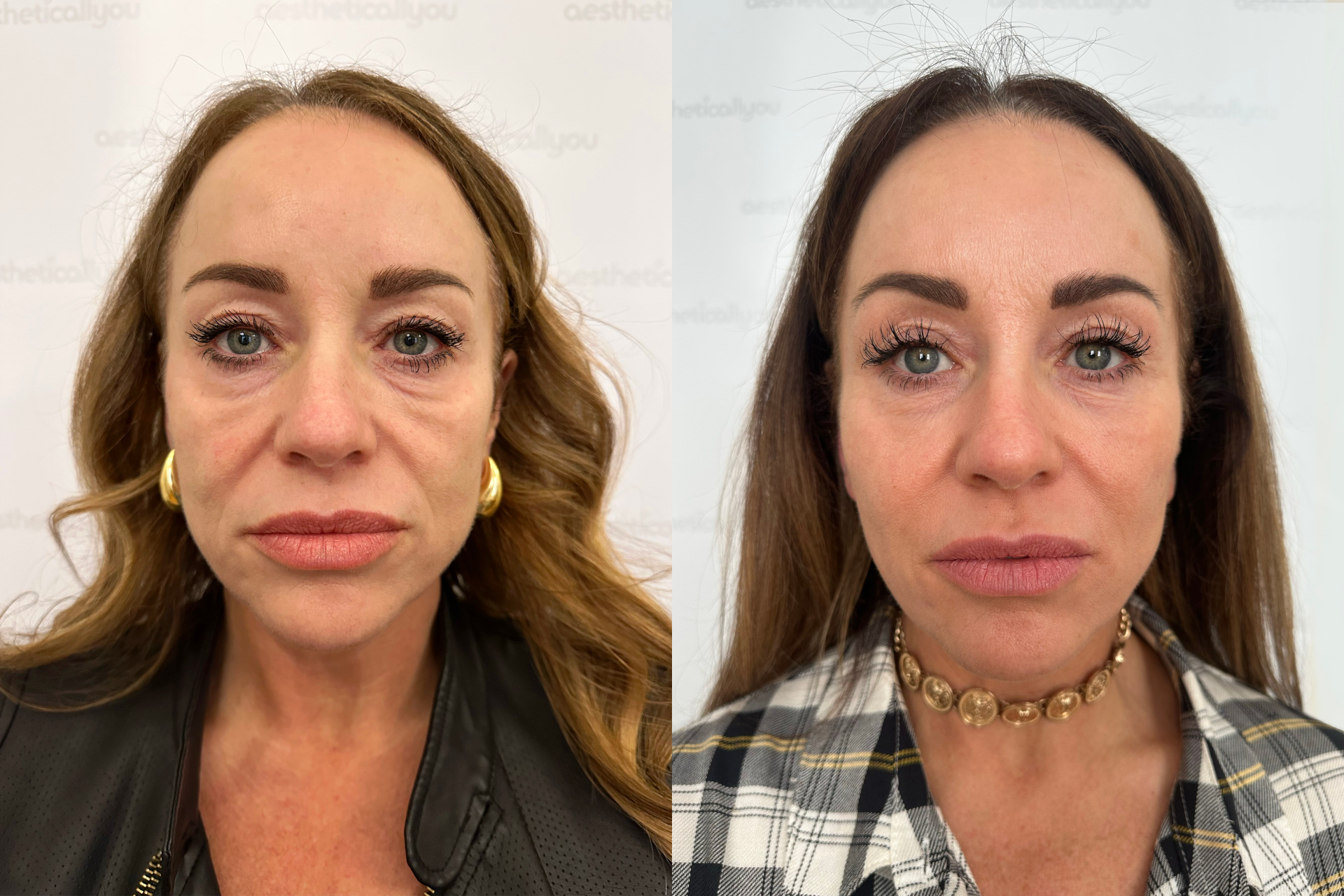 Before and after images of woman treated with Sculptura