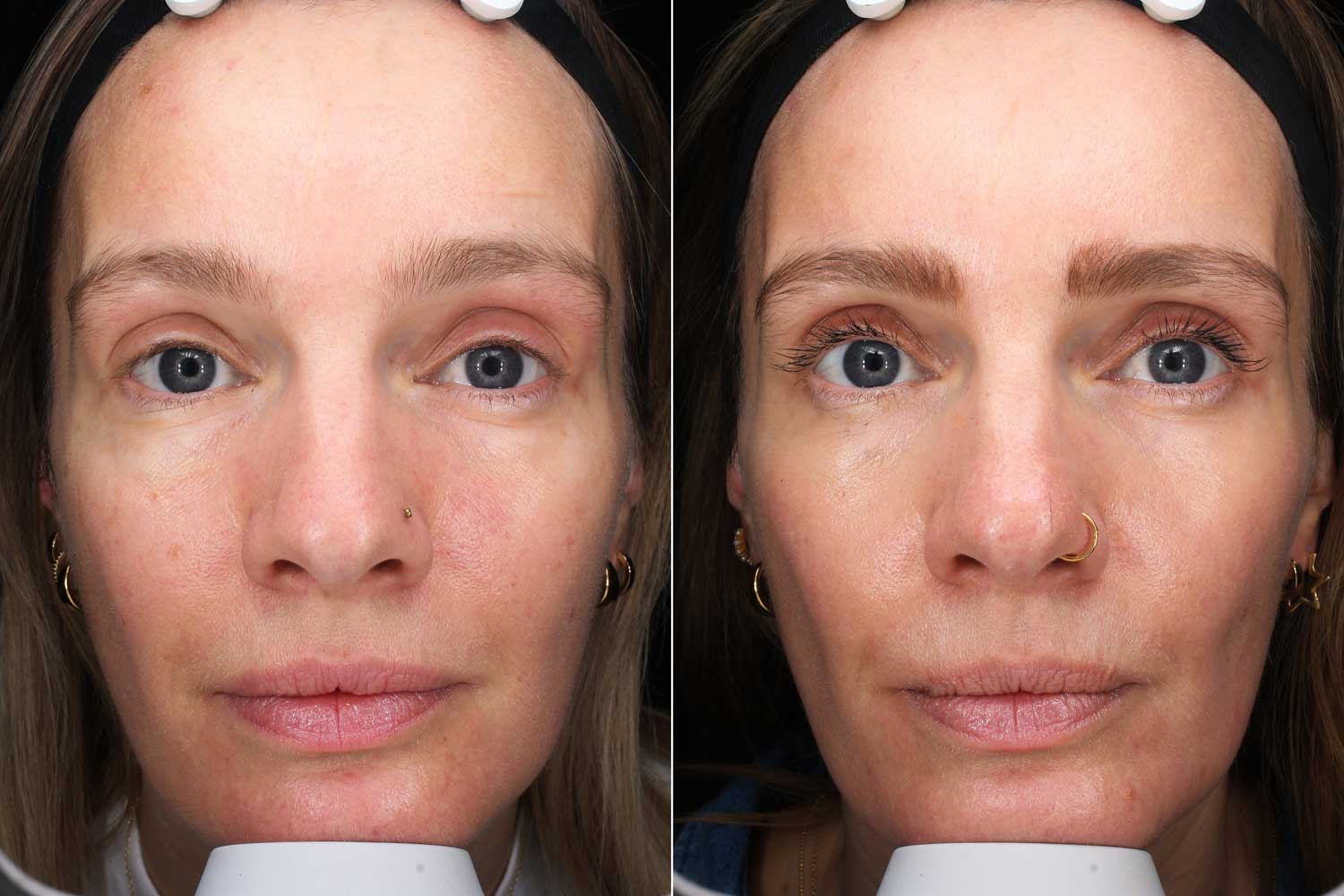 Rebecca Cox laser skincare before & after