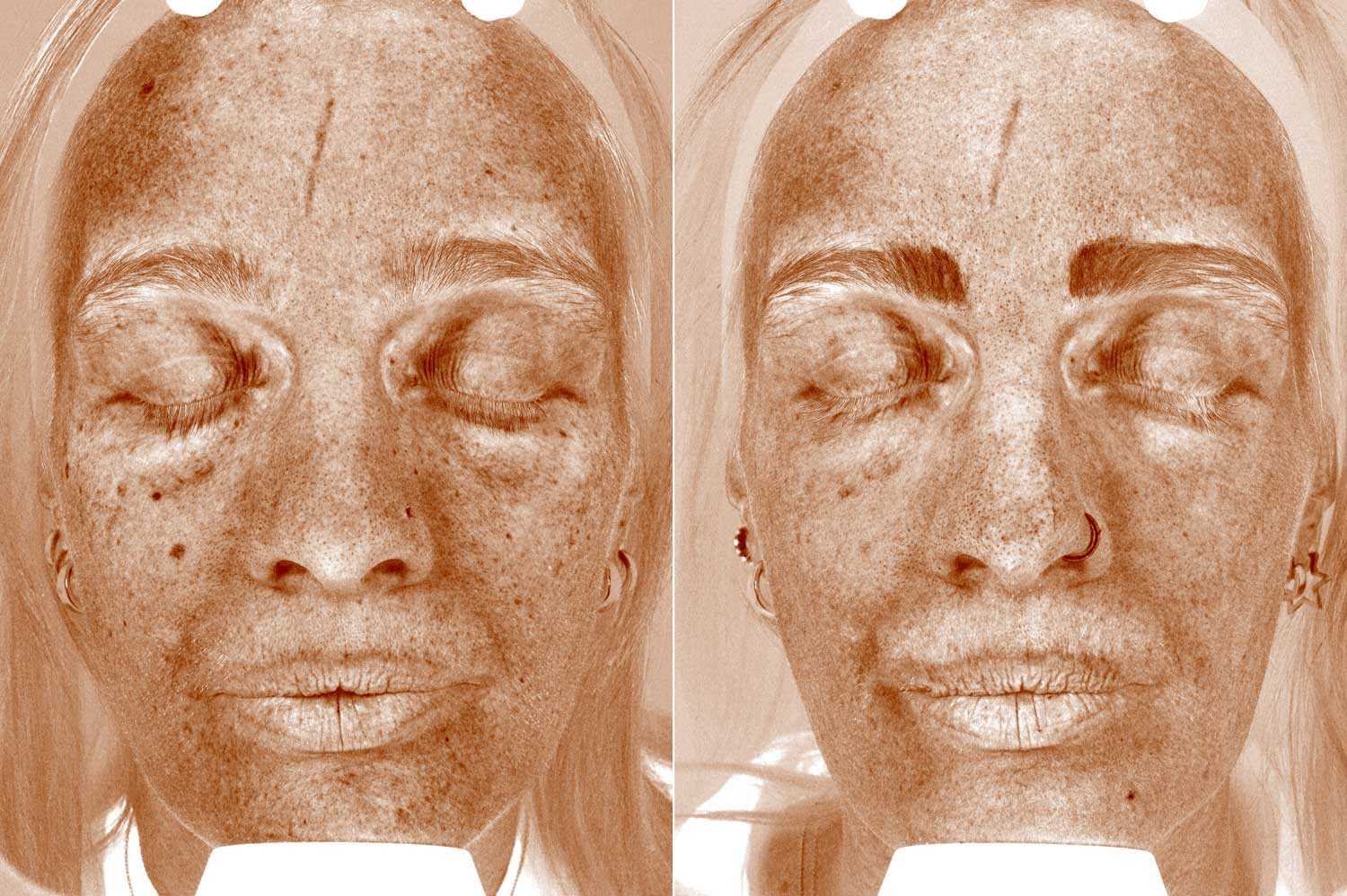 Rebecca Cox laser skincare before & after