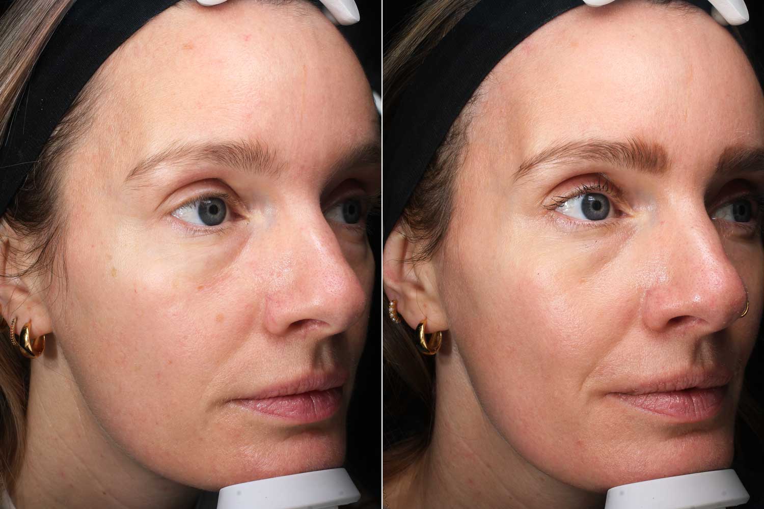 Rebecca Cox laser skincare before & after