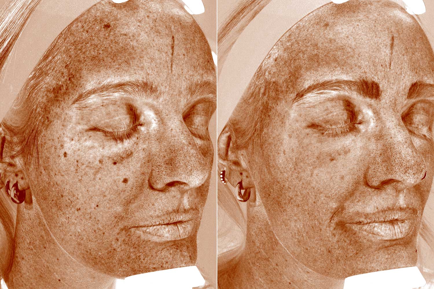 Rebecca Cox laser skincare before & after