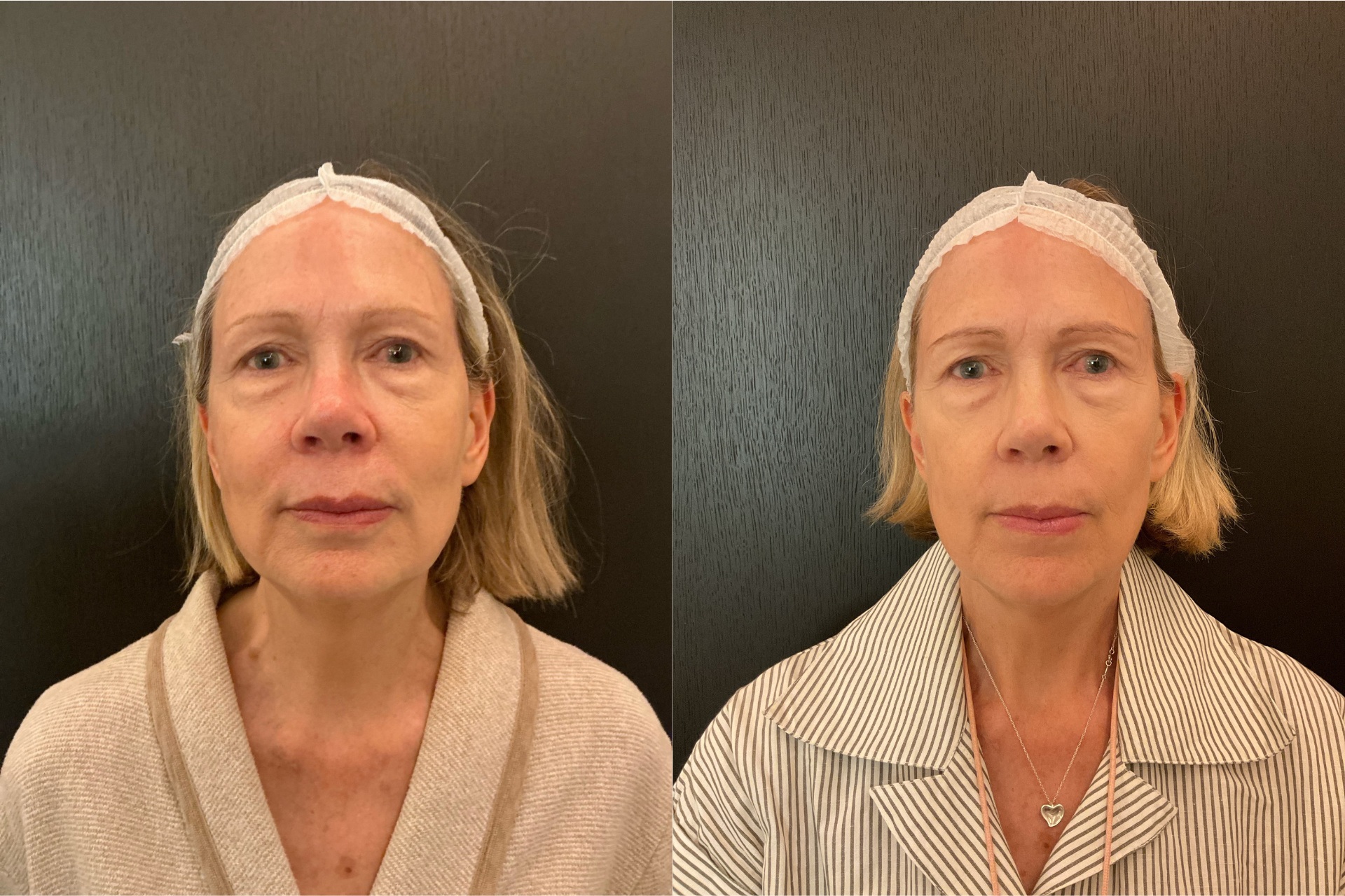 Juliet Herd Sofwave before and after